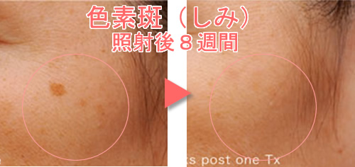 シミ治療前後