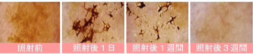 シミ治療前後３週間