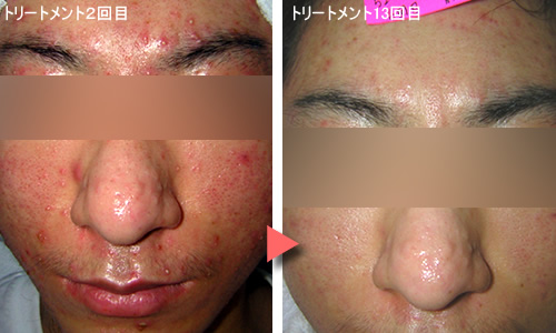 美肌トリートメント体験談写真
