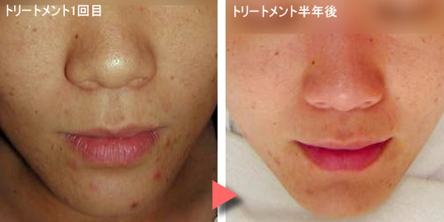 美肌トリートメント体験談写真